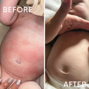 Facebook group subscription - baby eczema/ skin/ allergies